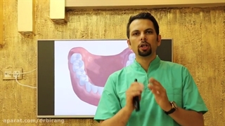 مراحل انجام ایمپلنت دندان