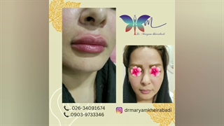 نمونه تزریق فیلر لب