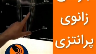 جراحی زانوی پرانتزی