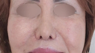 لیفت صورت | دکتر علی الستی