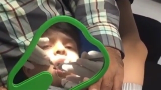 عصب کشی دندان کودک در تهران