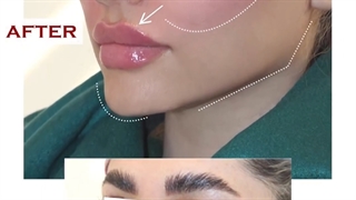مادلینگ‌دائمی صورت با تزریق چربی و تزریق ژل لب لیفت پیشانی
