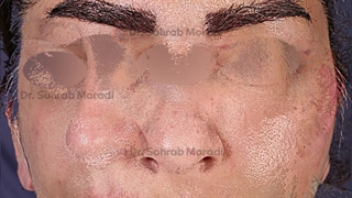 عمل زیبایی بینی - بهترین جراح زیبایی بینی