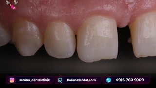 از بین بردن دیاستم یا فاصله بین دندان