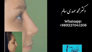 جراحی زیبایی بینی بعد از سه هفته | دکتر محمد مهدی سالم