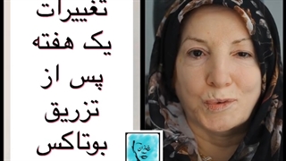 رفع بسته شدن غیر ارادی چشم با تزریق بوتاکس-دکتر محمد مهدی سالم درمان جای جوش