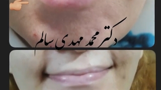 درمان فلج لب تحتانی با بوتاکس | دکتر محمد مهدی سالم