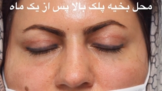 جراحی پلک بالا و پایین-دکتر محمد مهدی سالم کشیدن دندان