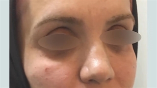 تزریق چربی به صورت | دکتر علی الستی