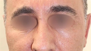 لیفت صورت در آقایان | دکتر علی الستی