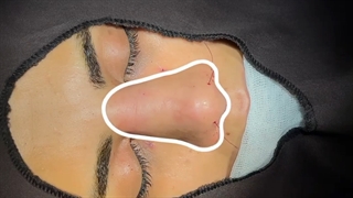 فیلم عمل بینی با پوست بسیار ضخیم