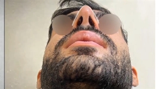 عمل بینی مردان