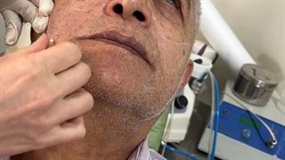 لیفت صورت با نخ جوانساز