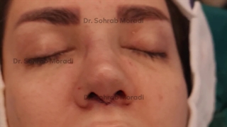 عمل زیبایی بینی  - بهترین جراح بینی در تهران