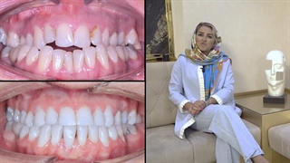 ارتودنسی بدون جراحی فک در سن بالا | دکتر داودیان