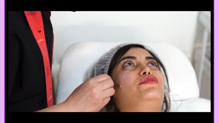 تزریق فیلر کاشت مو