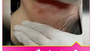 جوانسازی با میکرونیدلینگ تزریق بوتاکس