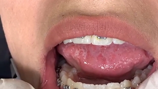 آموزش نحوه کشیدن نخ دندان در زمان ارتودنسی دندان