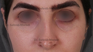 عمل زیبایی بینی  - بهترین جراح بینی در تهران