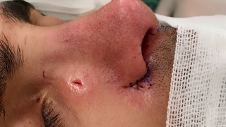 ویدیو نمونه کار جراحی زیبایی بینی در شیراز - دکتر مسعود جانی پور لیفت صورت