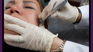 میکرو درم آبریژن پیلینگ