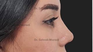 لیفت اندوسکوپی ابرو و عمل زیبایی بینی - دکتر سهراب مرادی