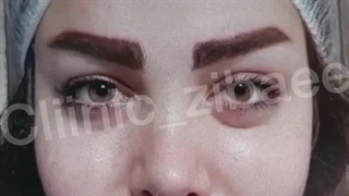 بلفاروپلاستی و جراحی پلک بالا