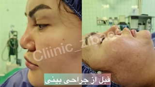 جراحی بینی عمل بینی