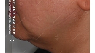 ️اندولیفت، به عنوان موثرترین و جدیدترین روش غیرجراحی رفع غبغب و زاویه سازی خط فک