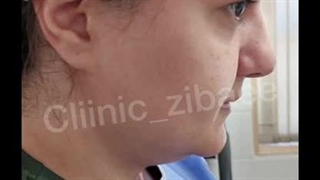 لیپوساکشن غبغب و بلفاروپلاستی یوسف آباد