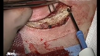 عمل جراحی ماستوئیدیت توسط دکتر فرامرز معماری