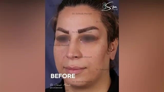 بلافاصله پس از عمل زیبایی بینی - فوق تخصص جراحی پلاستیک و زیبایی