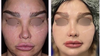 رضایت زیباجوی عزیز 3 هفته پس از لیفت ثانویه صورت و گردن