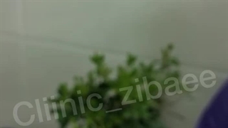 ۸ روز بعد از بلفاروپلاستی (جراحی پلک)