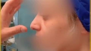 رینوپلاستی