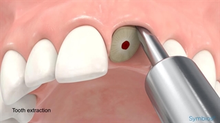 ایمپلنت دندان جلو چگونه انجام می شود؟