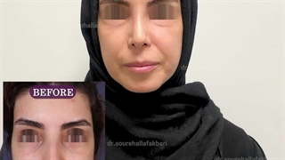 شش ماه بعد از جراحی بینی