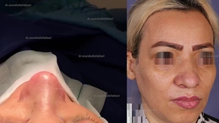 قبل و بعد از جراحی زیبایی بینی