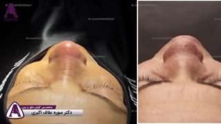 جراحی ترمیمی بینی با غضروف دنده