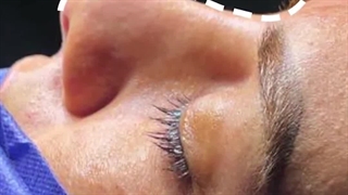 جراحی زیبایی بینی گوشتی