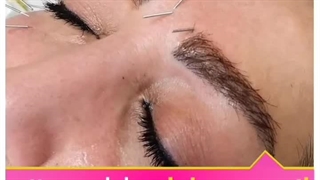 رفع غبغب و خط اخم وخنده با طب سوزنی