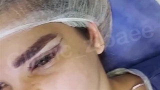 بلافاصله بعد از بلفاروپلاستی پلک‌بالا