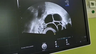 تخلیه تخمک ها در IVF