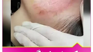 از بین رفتن جوش و جای جوش با میکرونیدلینگ پیلینگ شیمیایی