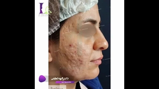 از بین بردن جای اسکار آکنه با دستگاه پزشکی Aphrodite
