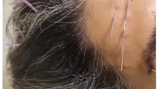 جوانسازی با انجام طب سوزنی