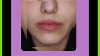 مراقبت های بعد از تزریق فیلر اندودنتیکس