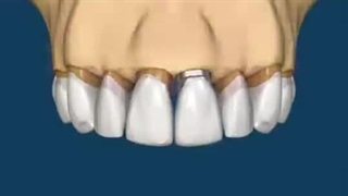 انیمیشن ایمپلنت و بریج دندان