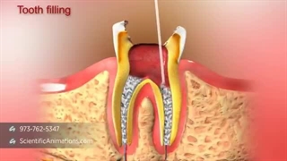 انیمیشن عصب کشی دندان