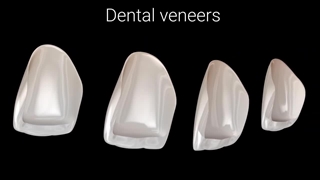 انیمیشن لمینیت دندان